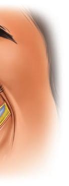 The lid is then everted, and a second corresponding incision is made through conjunctiva and tarsus.