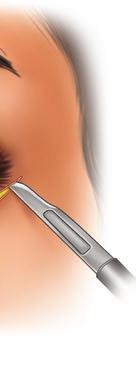 The closer these sutures are passed to the lashes, the more rotation is achieved.