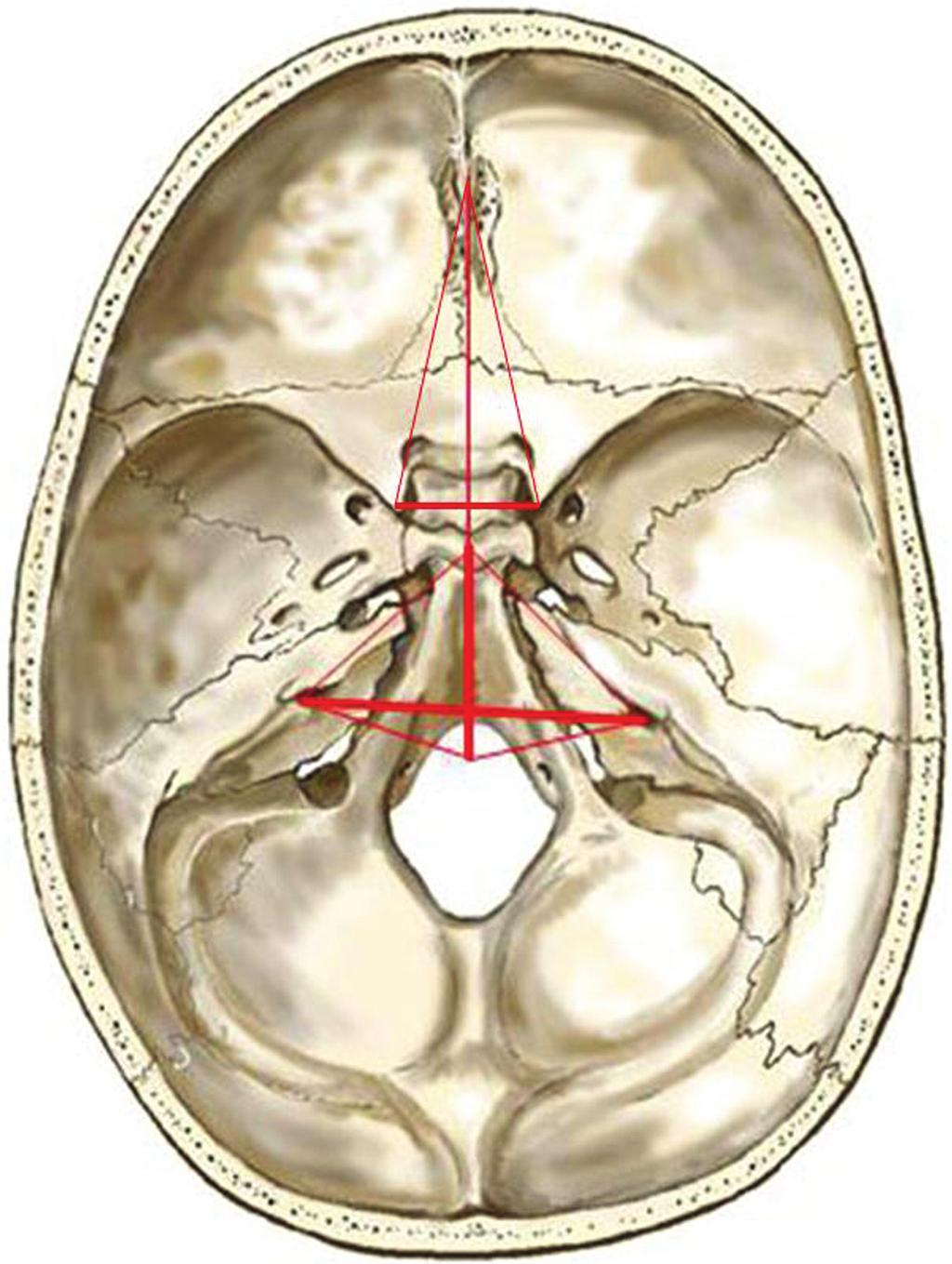 Skull base growth and CM-I Clinical Material and Methods Outline of the Study Using a segmentation technique already described, anatomical osseous landmarks of the skull base were identified on axial