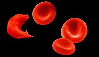 Review Questions 1. Consider the statement: Sickle cell disease is a(n) disease. 2. If a person has sickle cell anemia, what must be true about their parents? a. One parent has at least one copy of the sickle cell allele b.