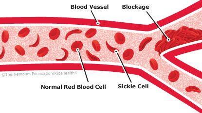 Summary Sickle cell anemia is a genetic disease Red blood cells become misshapen (crescents instead of discs) Prevents oxygen from being delivered to other parts