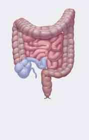 If You Have Surgery Surgery can ease ulcerative colitis and Crohn s disease symptoms. For ulcerative colitis, surgery may rid you of all symptoms related to the digestive tract.