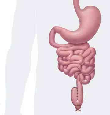 Portion of intestine removed Ends of intestine sewn together Limited Bowel Resection This surgery is done more for Crohn s disease than for ulcerative colitis.