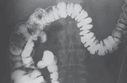 An x-ray image from a barium enema Endoscopy (also called sigmoidoscopy and colonoscopy) allows the doctor to look directly into the rectum or colon.