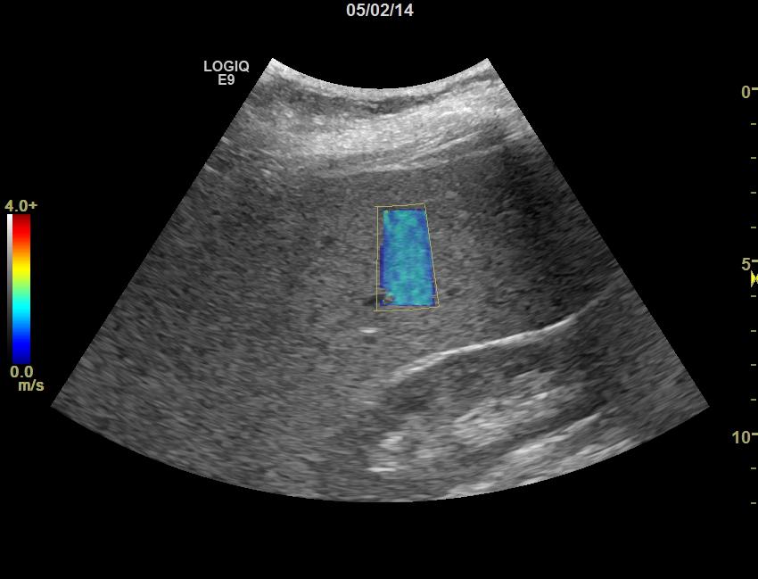 Shear Wave Elastography Implementation on the LOGIQ E9 GE s implementation of Shear Wave elastography on the LOGIQ E9 displays 2D images of Shear Wave speed or Young s Modulus in a region of interest