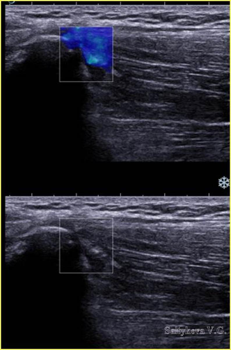 Images for this section: Fig. 1: Group 1. Ultrasound image. Shear Wave Elastography. The proximal muscles Gluteus attachment. SWE.