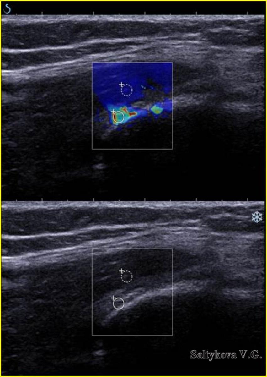 Fig. 2: Group 2. Myofascial pain syndrome, the proximal muscles Gluteus attachment. Ultrasound image, Shear Wave Elastography.