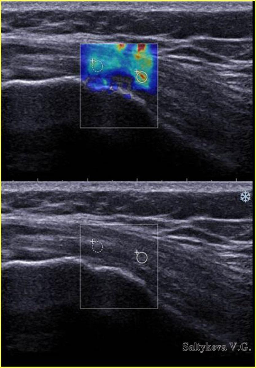 Fig. 3: Group 2. Myofascial pain syndrome, the proximal muscles attachment sites of the outer thigh, the distal muscles Gluteus attachment. Ultrasound image, Shear Wave Elastography.