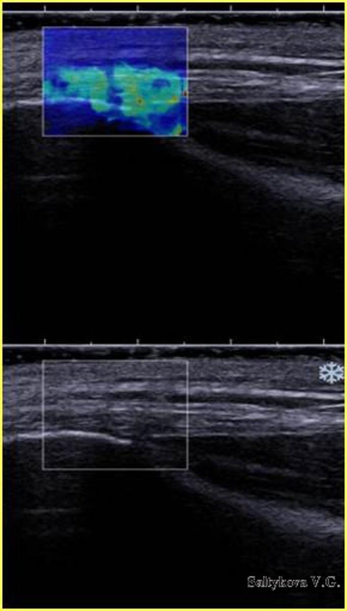 Fig. 4: Group 2. Myofascial pain syndrome, the proximal muscles attachment sites of the outer thigh, Fascia latae. Ultrasound image, Shear Wave Elastography.