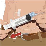 If more than one site is used, repeat the steps. Check for proper needle placement by pulling back on the syringe plunger to check for blood return in the tubing of the needle set.