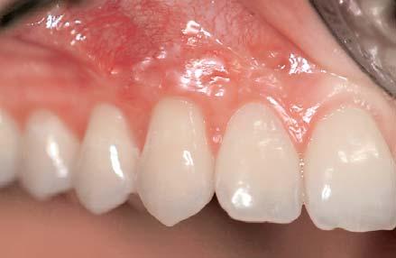 Jankovic et al Use of PRP with CTG 69 Fig 12 Post-operative (6 months) view of the outcome of gingival recession treatment with CTG and PRP. Note the significant increase of keratinised tissue width.