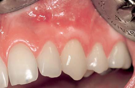 Note the appreciably smaller gain of keratinised tissue in comparison with gingival recession treated with CTG+PRP. 3.11 ± 0.32 and 4.20 ± 0.27 respectively.