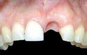 side with mucoderm and recession treatment of tooth