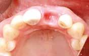 millimeters) ready for gingival augmentation Implant