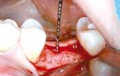 mucoderm for the thickening of periimplant soft tissue MUCOSAL THICKENING AROUND BONE LEVEL IMPLANTS 12 Dr.