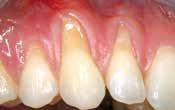 Application of mucoderm in plastic-aesthetic periodontal surgery Gingival recessions are not only an aesthetic issue. They can also lead to clinical Prof. Dr.