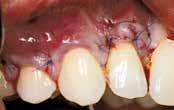 before treat- A sulcular incision from tooth 11 to 15 is made and a split-full- Hydrated mucoderm is trimmend and placed over the The flap is coronally repositioned over the root surfaces