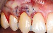 root cover- leveling of the FGG the flap over mucoderm and
