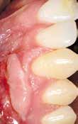 increased thickness of the tooth roots marginal tissue COVERING