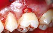 post-operative of gingival recessions.