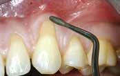 TECHNQIUE (MCAT) Gingival recession at tooth 13 mucoderm is