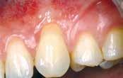 mucoderm, Clinical situation at three Situation after gingival