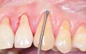 tooth by means of sling sutures.