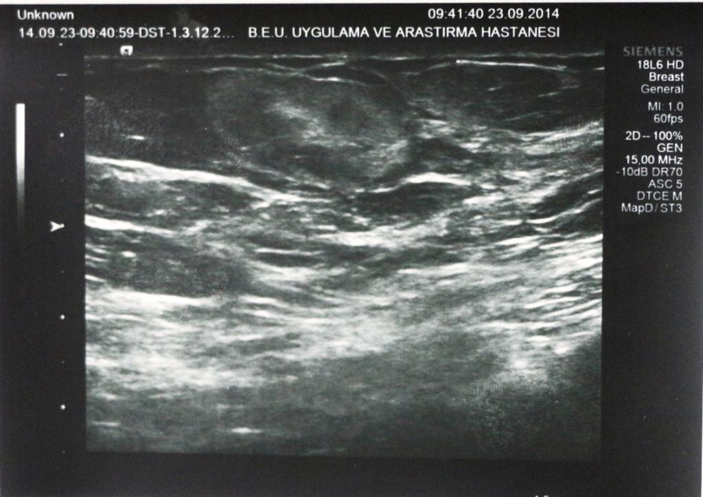Fig. 6: The mass has smooth lobulations, slightly hyperechoic relative to the normal fat lobules on sonogram.