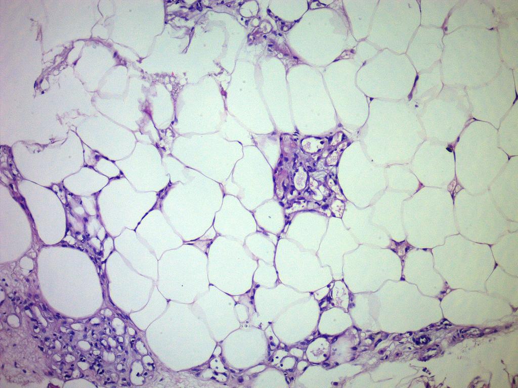 Fig. 7: Lipomatous tissue rich in vascular structures some of which contains thrombus.