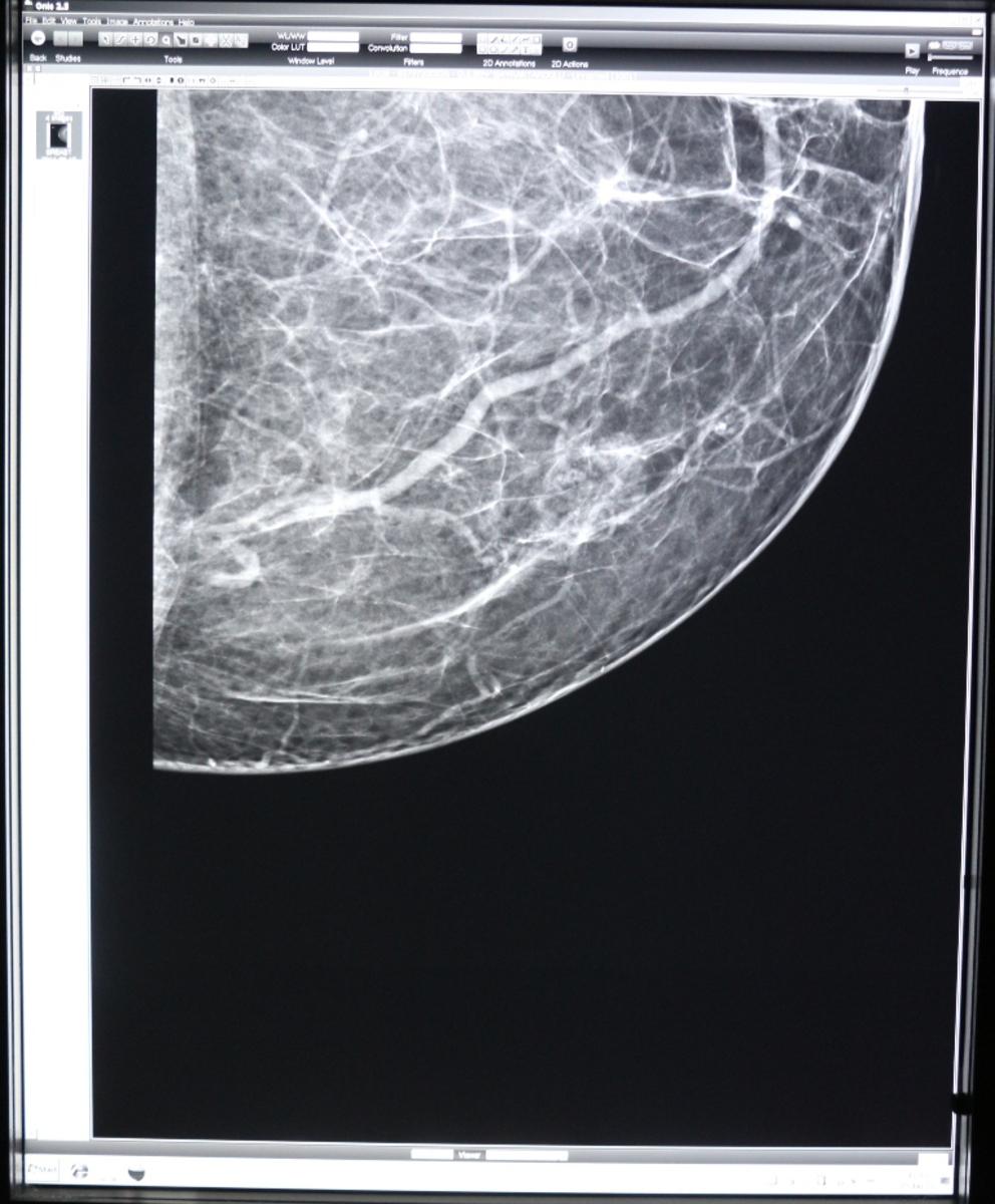 Fig. 5: 45 years old women with a palpable left breast mass, who had a circumscribed isodense mass lesion on mammogram