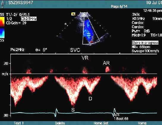 Superior Vena Cava Doppler Flow Changes in Superior Vena Cava Syndrome 13 the smaller of the VR- and AR-waves were, the farther the oppressed