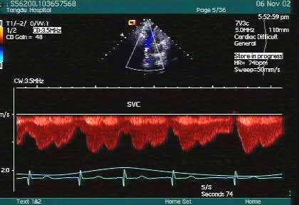 Doppler interrogation of the SVC shows systolic and diastolic phases of flow (S- and D-waves) toward the heart and late ventricular systolic