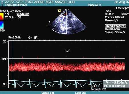 14 Establishing Better Standards of Care in Doppler Echocardiography, Computed Tomography and Nuclear Cardiology Fig. 17. SVC Doppler flow spectra in severe SVCS.