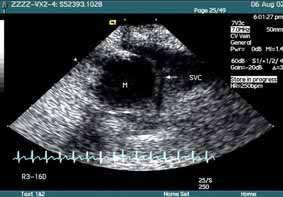 6 Establishing Better Standards of Care in Doppler Echocardiography, Computed Tomography and Nuclear Cardiology Fig. 2. Two-dimensional ultrasonography of a rabbit with SVCO Fig. 3.