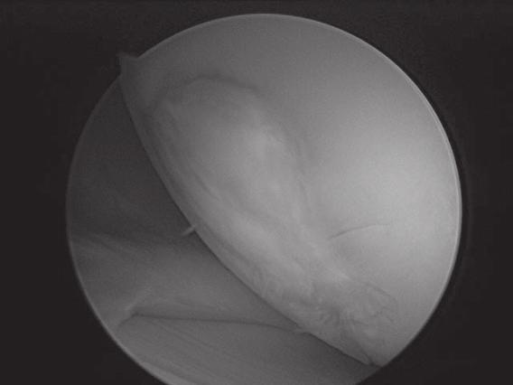 OSTEOCHONDRAL AUTOGRAFT TRANSFER The concept of osteochondral autograft transfer (OAT) for cartilage repair was introduced by Bobić 2 (single plugs) and Hangody 8 (multiple plugs or Mosaicplasty ) in