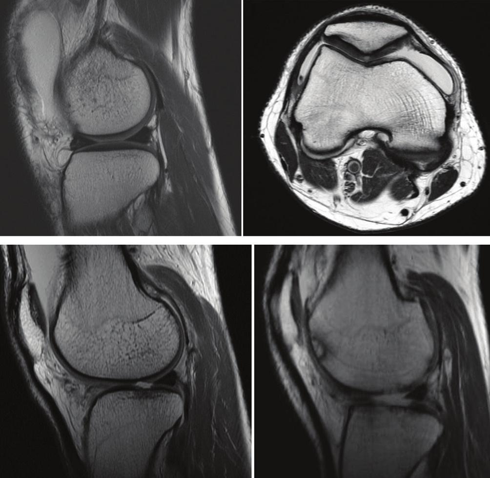 Sensitivity for iw FSE ranged from as high as 97% for medial tibial to as low as 6% for lateral femoral and tibial s. Specificity was greater than 90% and accuracy ranged from 88% to 96%respectively.