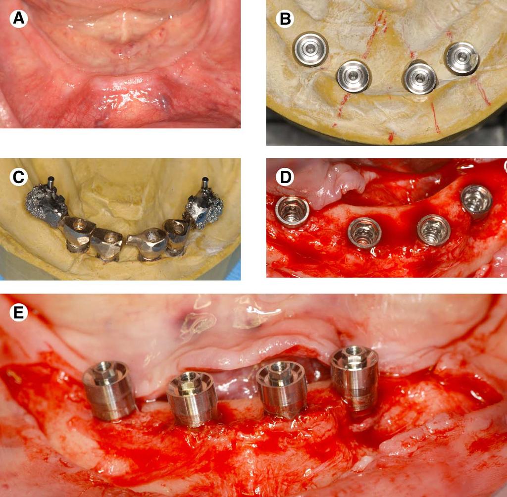 34 IMMEDIATE LOADING OF THE EDENTULOUS MANDIBLE FIGURE 2. Case demonstrating delivery of immediate final prosthesis after implant placement. A, Edentulous mandible before placing implants.