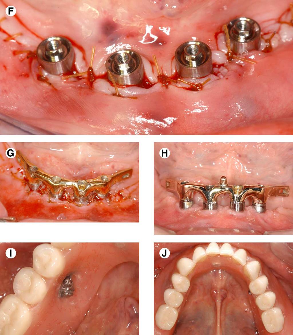 CASTELLON ET AL 35 FIGURE 2 (cont d). F, The gingiva is sutured around the abutments, leaving the abutments exposed for the dentist to index the segmented bar on the day of implant placement surgery.