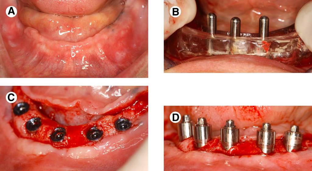 36 IMMEDIATE LOADING OF THE EDENTULOUS MANDIBLE FIGURE 3. Case demonstrating delivery of immediate prosthesis after implant placement. A, Edentulous patient before receiving implants.