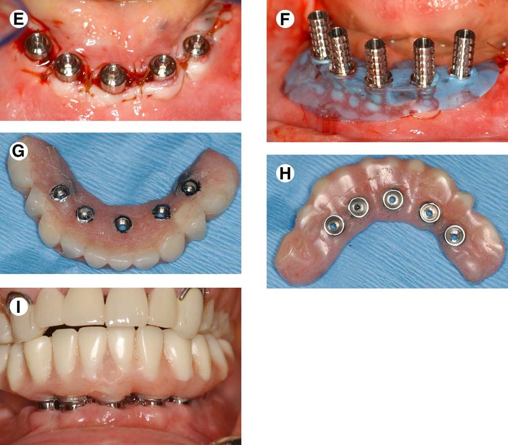 CASTELLON ET AL 37 FIGURE 3 (cont d). E, The gingiva is sutured to leave the abutments exposed for the dentist to attach the temporary cylinders to the modified denture.
