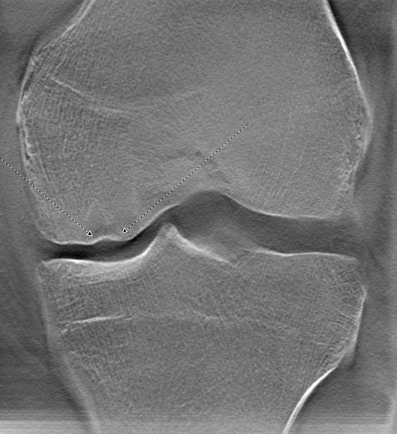 2 - Knee Case Femoral Insufficiency Fractures Tomosynthesis shows bicondylar femoral insufficiency fractures with greater resolution of bone detail than MRI