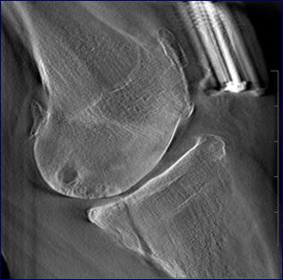 C.5 - Knee Case Occult fracture A displaced fibial fracture