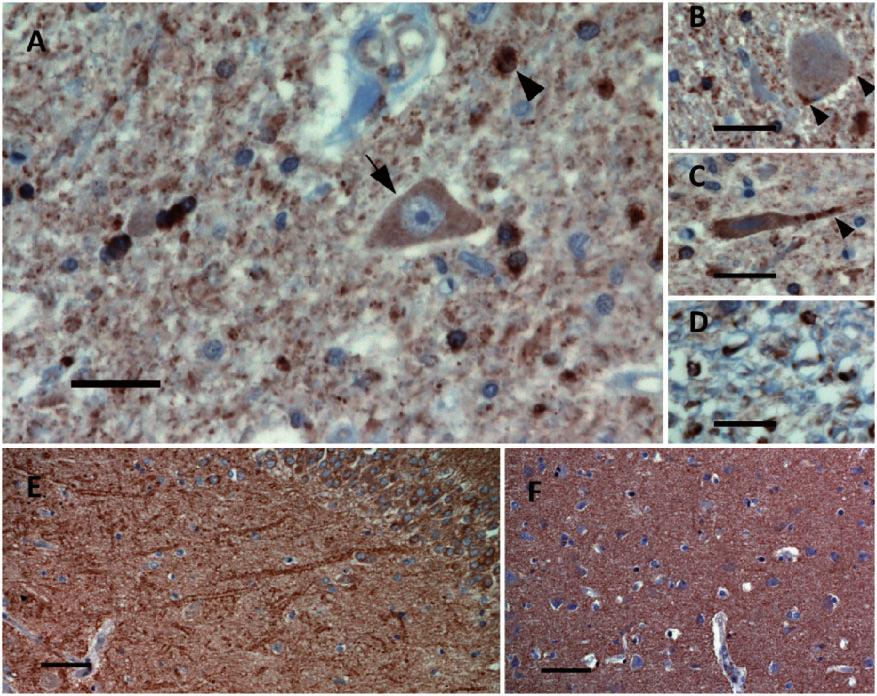 ALS phenotype from C9ORF72 expansions Brain 2012: 135; 751 764 759 Figure 5 Immunohistochemistry for C9ORF72 shows similar features in neurologically healthy controls and individuals with motor