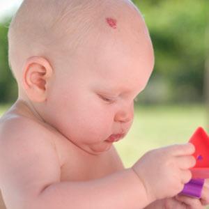KNOWING WHEN TO CONSIDER TOPICAL THERAPY Superficial hemangiomas Impending