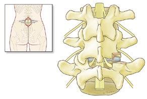 Expose the facets and the lateral parts of facet joints on the affected side.