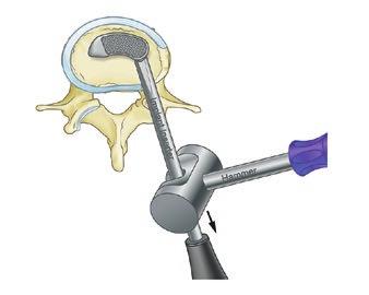 Surgical Technique Implant Insertion Completion of Surgery / Postoperative Care The stable longitudinal alignment of the Implant and the Inserter ensures a straight introduction of the