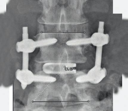 accompanying radicular symptoms, ruptured or herniated discs, and pseudarthrosis or failed spondylodesis. Patients should have at least six (6) weeks of non-operative treatment prior to surgery.