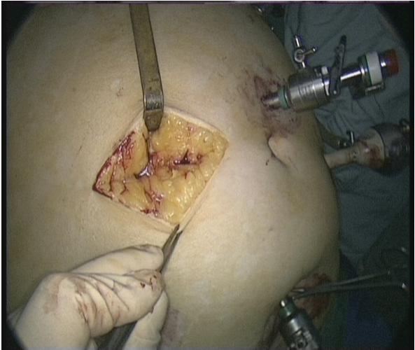 Surgical incisions: a midline or transvers incision