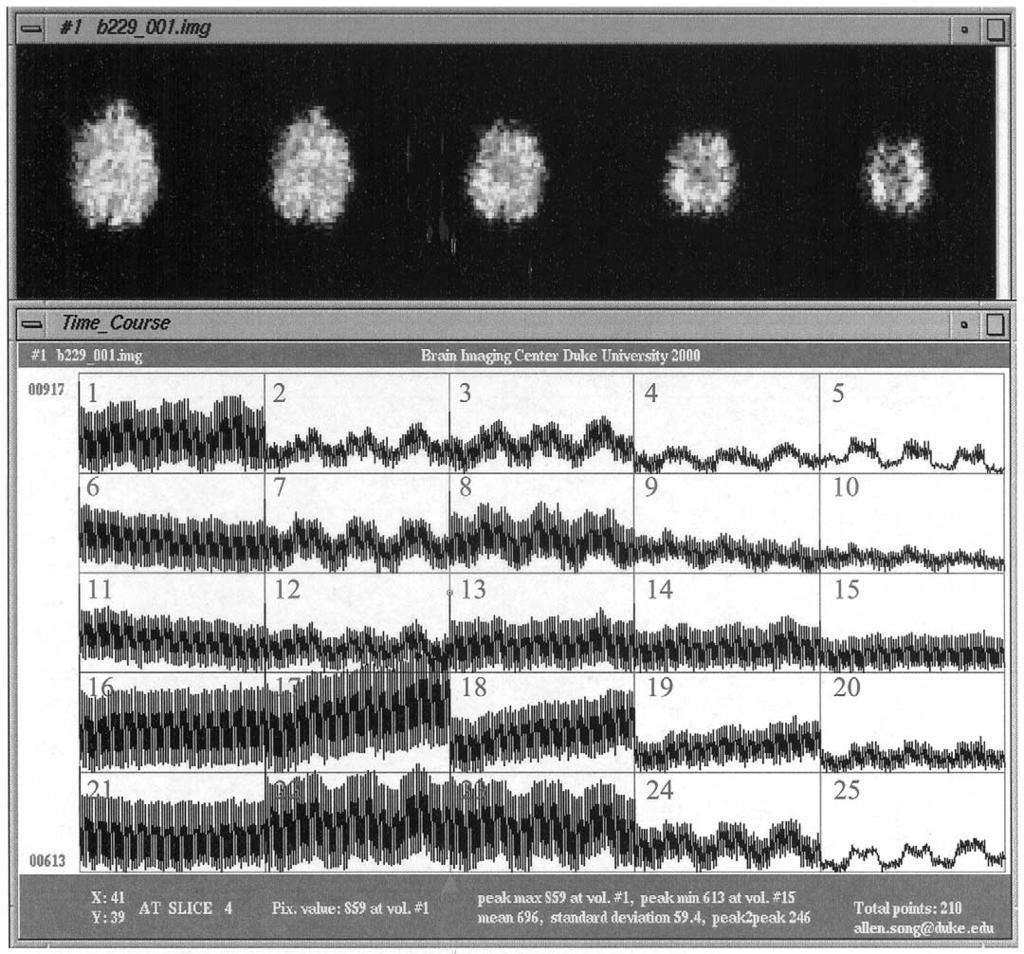 A.W. Song et al. / Magnetic Resonance Imaging 20 (2002) 521 525 523 Fig. 1. Spiral images using isotropic diffusion weighting in the presence of cyclically varying b factors.