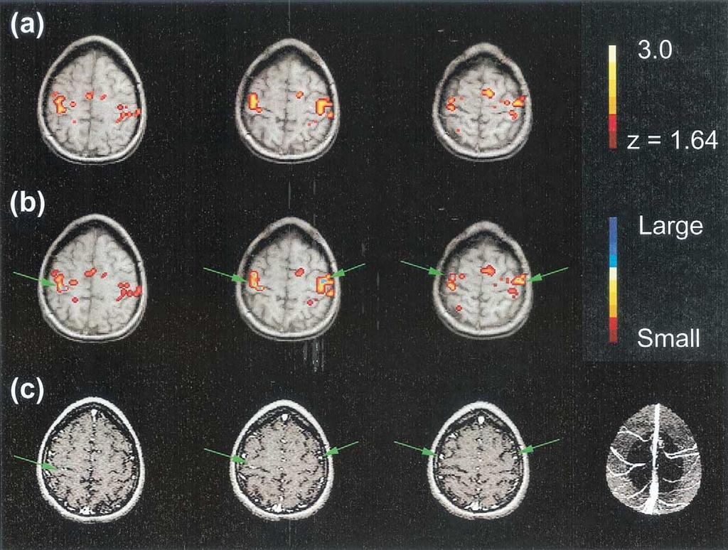 524 A.W. Song et al. / Magnetic Resonance Imaging 20 (2002) 521 525 Fig. 2. (a) Activated area of BOLD contrast determined by statistical tests with linear detrending; the Z-score threshold was 1.64.